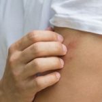 &iquest;C&oacute;mo se trata la piel con ros&aacute;cea?: manchas en la piel y deporte heelespana 150x150 - HeelEspa&ntilde;a