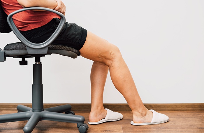 ¿Cuáles son los síntomas de la mala circulación en las piernas? - HeelEspaña