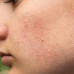 Gu&iacute;a de cuidados para la piel sensible: dermatitis piel uso mascarilla 150x150 - HeelEspa&ntilde;a