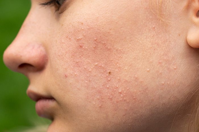 La dermatitis es uno de los problemas de la piel con el uso de mascarilla