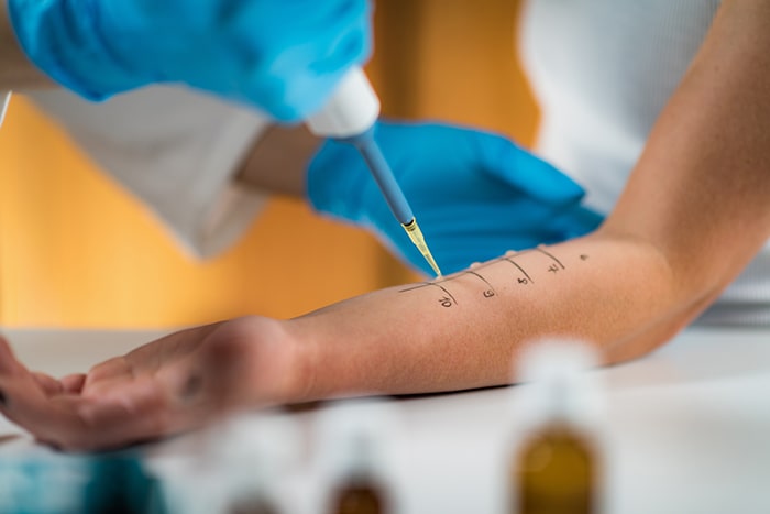 ¿Son frecuentes las reacciones alérgicas en verano?