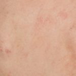 C&oacute;mo identificar mi tipo de piel: manchas piel 150x150 - HeelEspa&ntilde;a