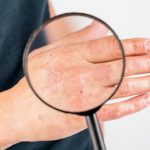 Dermatitis nerviosa: qu&eacute; es y c&oacute;mo tratarla: dermatitis manos 150x150 - HeelEspa&ntilde;a