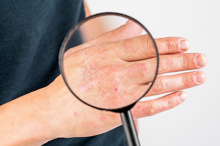 Dermatitis en las manos