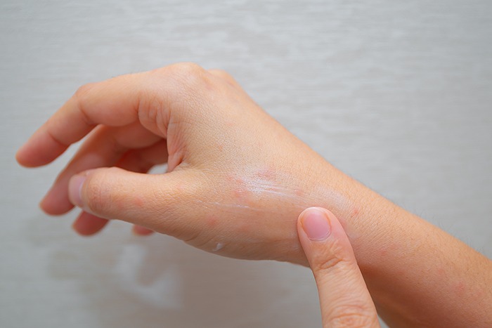 microbiota-dermatitis-atopica Dermatitis atópica