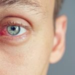 Importancia de la hidratación para la salud ocular en verano - HeelEspaña Importancia de la hidratación para la salud ocular en verano: portada ojos rojos irritados 150x150 - HeelEspaña