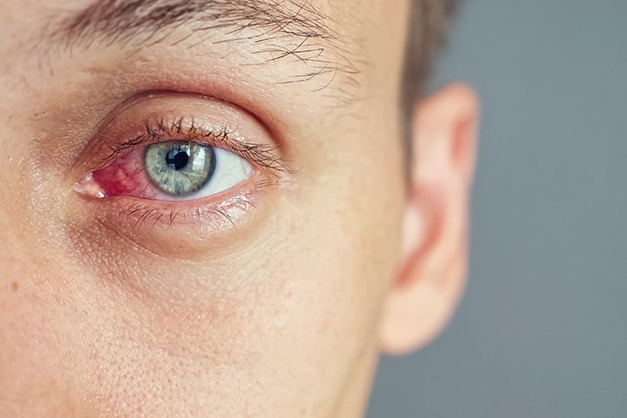 Ojos rojos e irritados